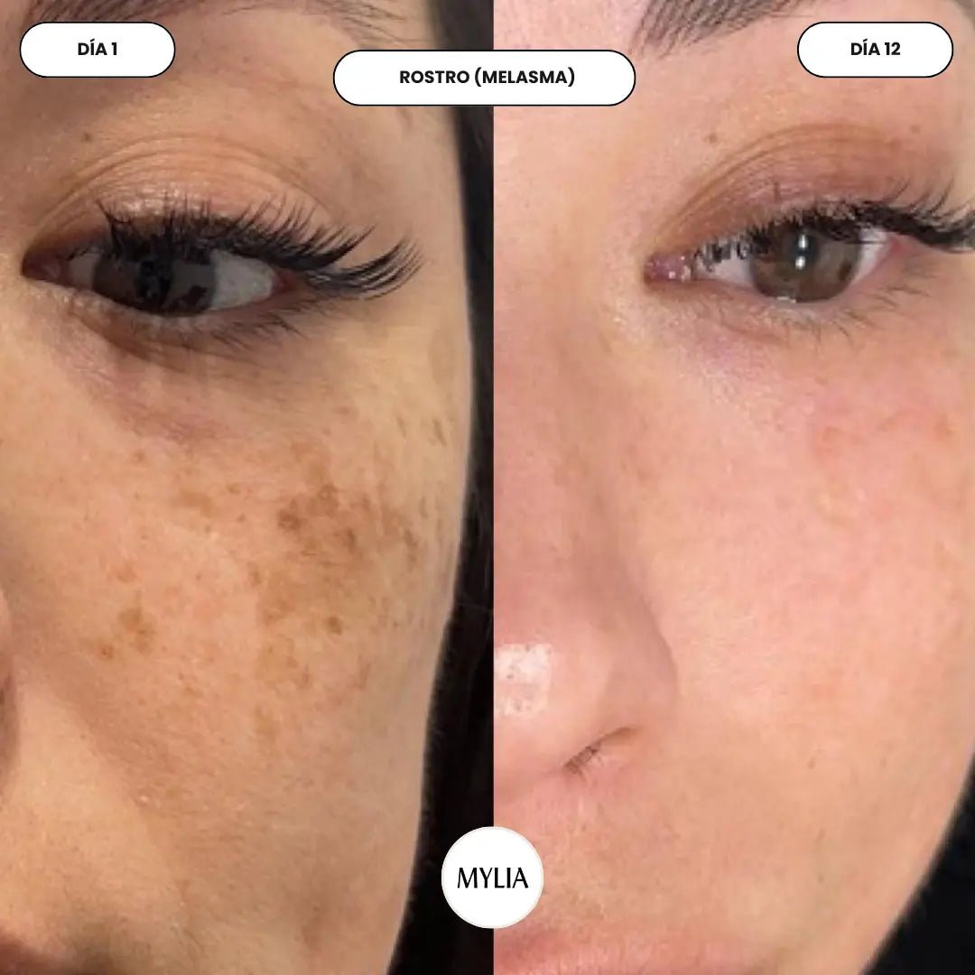 It evens out skin tone and visibly reduces persistent dark spot. - Mylia Care